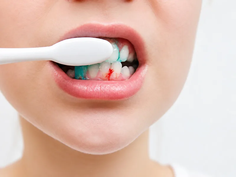 Chải răng quá mạnh có thể làm tổn thương và gây chảy máu nướu.